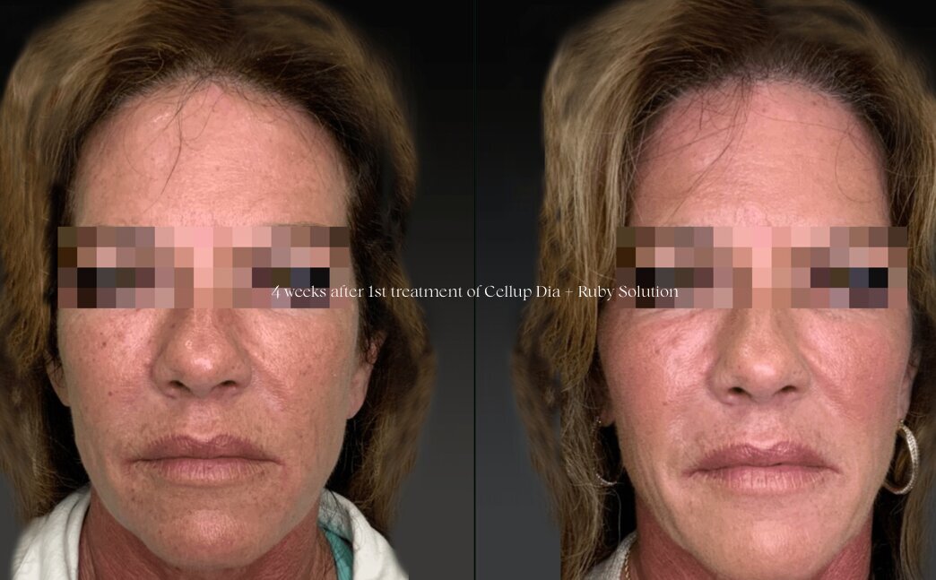 klaride-skin-booster-before-after-5