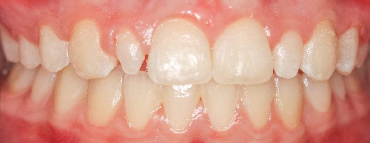 peg lateral tooth thrive dental