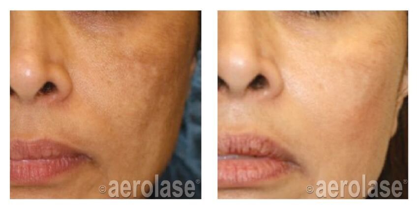 NeoSkin Melasma - After 1 Treatment combined with Hydroquinone - Cheryl Burgess MD