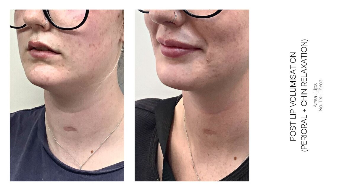 Best South Coast Lip Injection Before and After 25