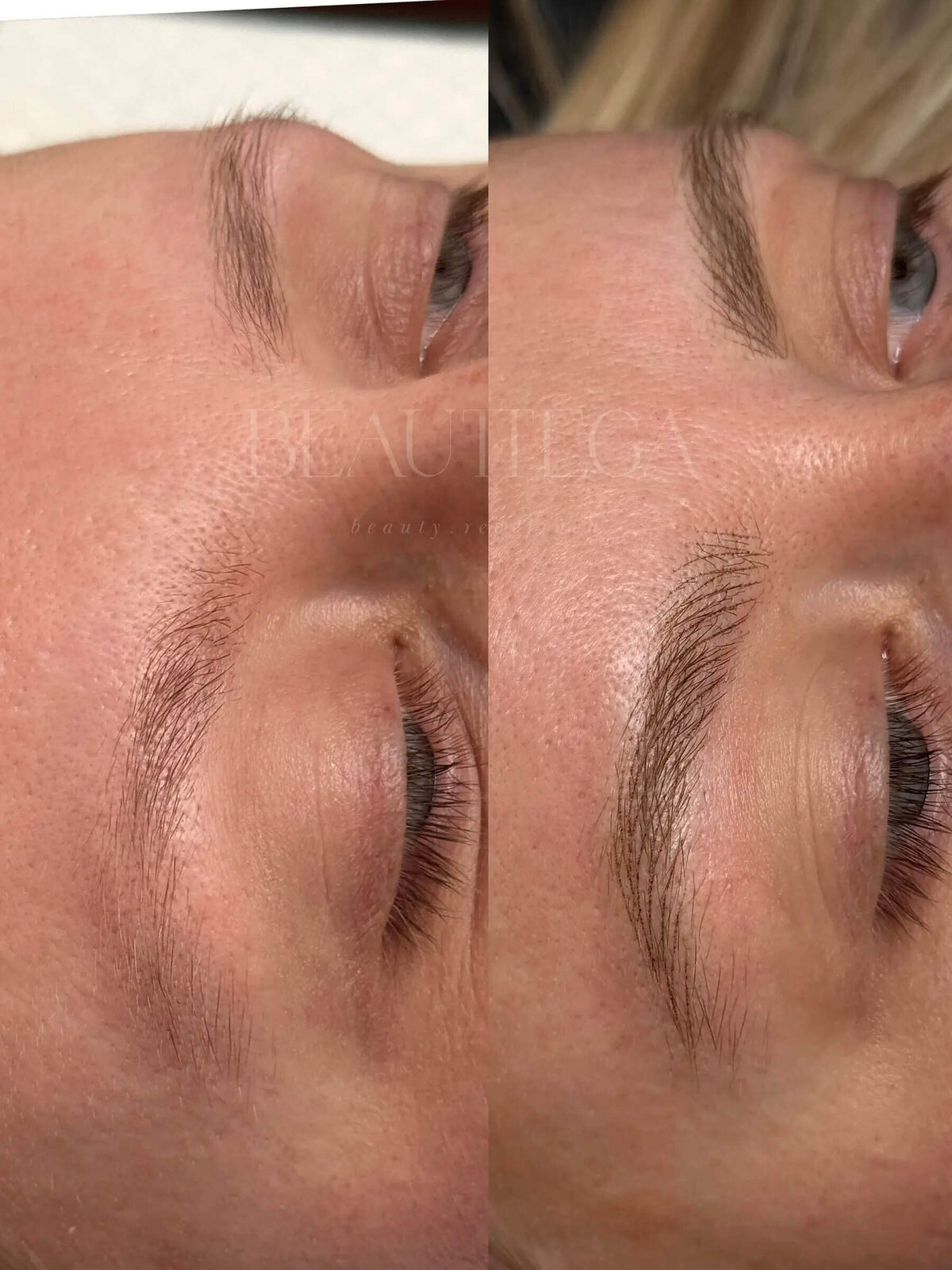 Beauttega E Nano Machine Hair Strokes 6 (C+R)