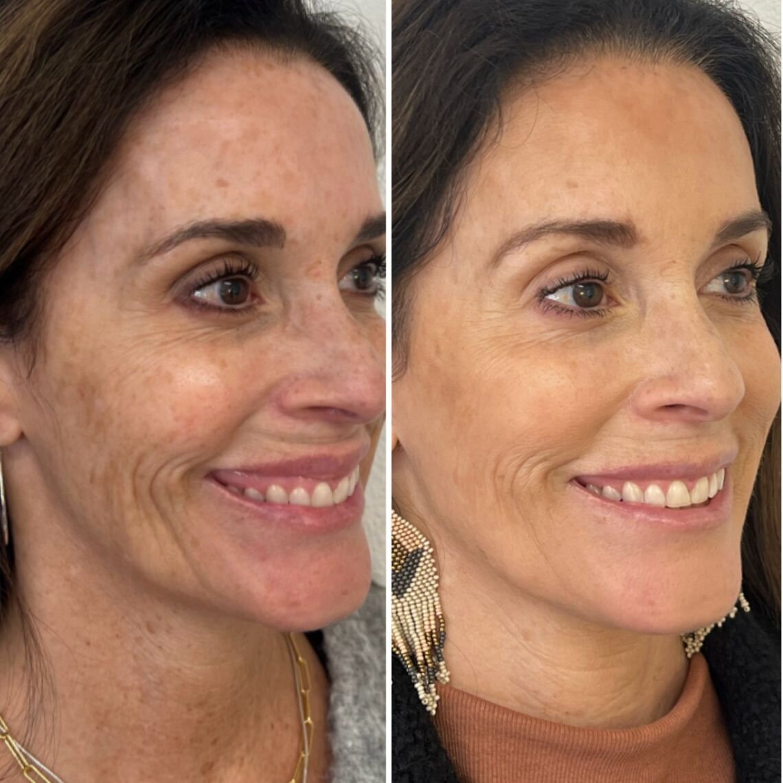 compressed-sculptra-before-after-02