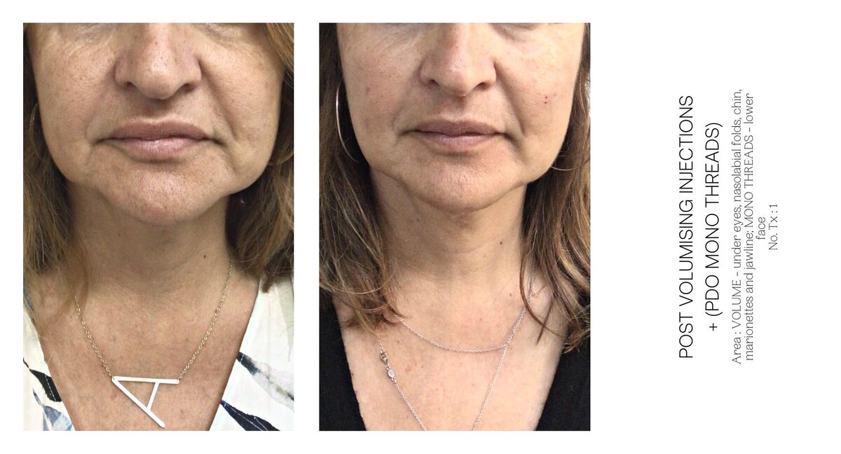 Chin Injections Before and After 7