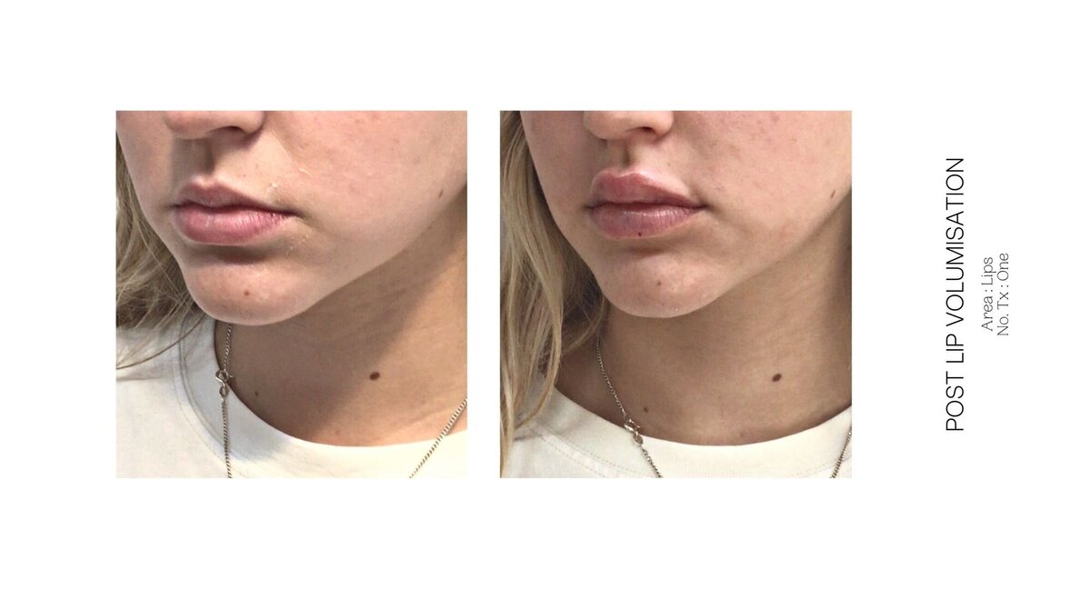 Best South Coast Lip Injection Before and After 36