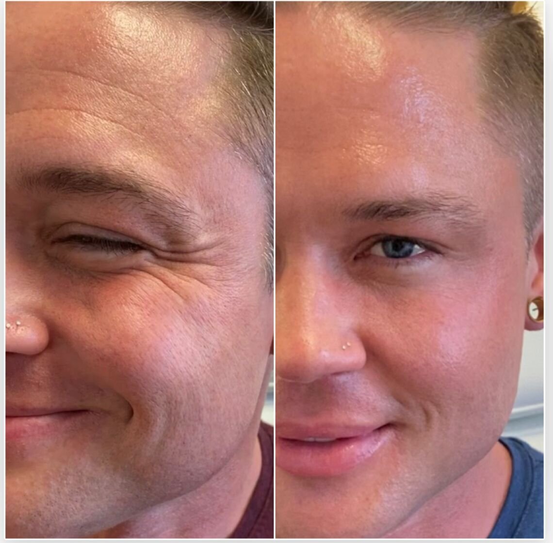 compressed-Neuromodulator-before-after-07