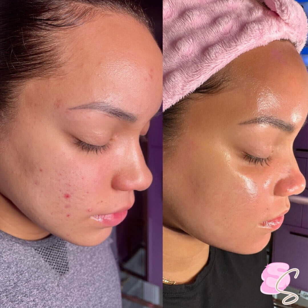 Microneedling before _ after 