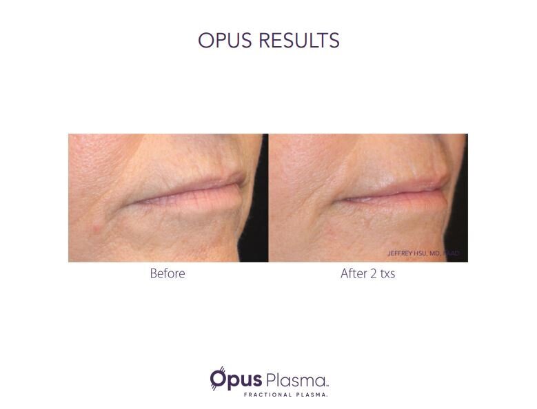 Opus Results Picture 8