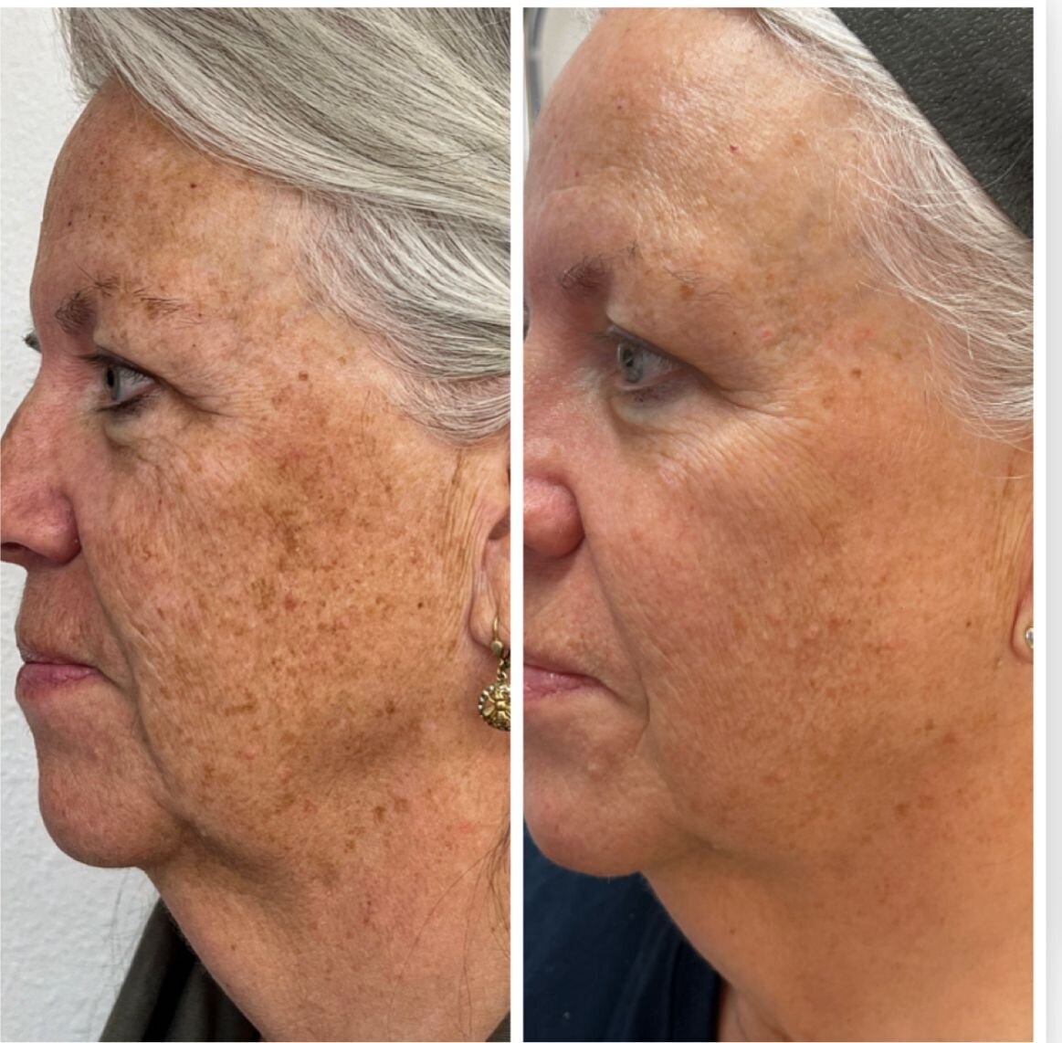 bbl-before-after-06