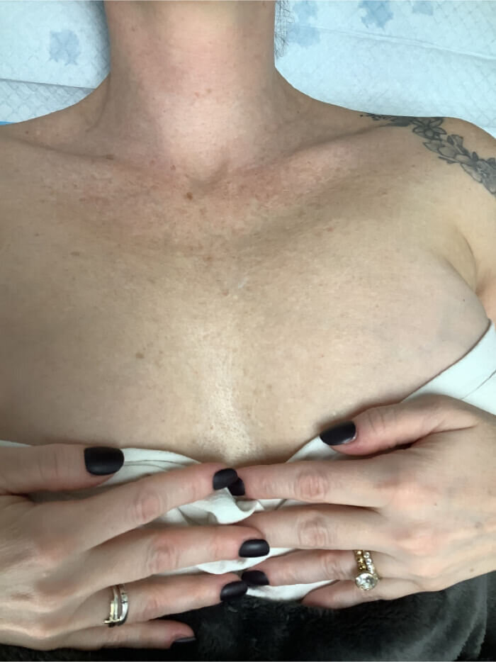 after ipl chest