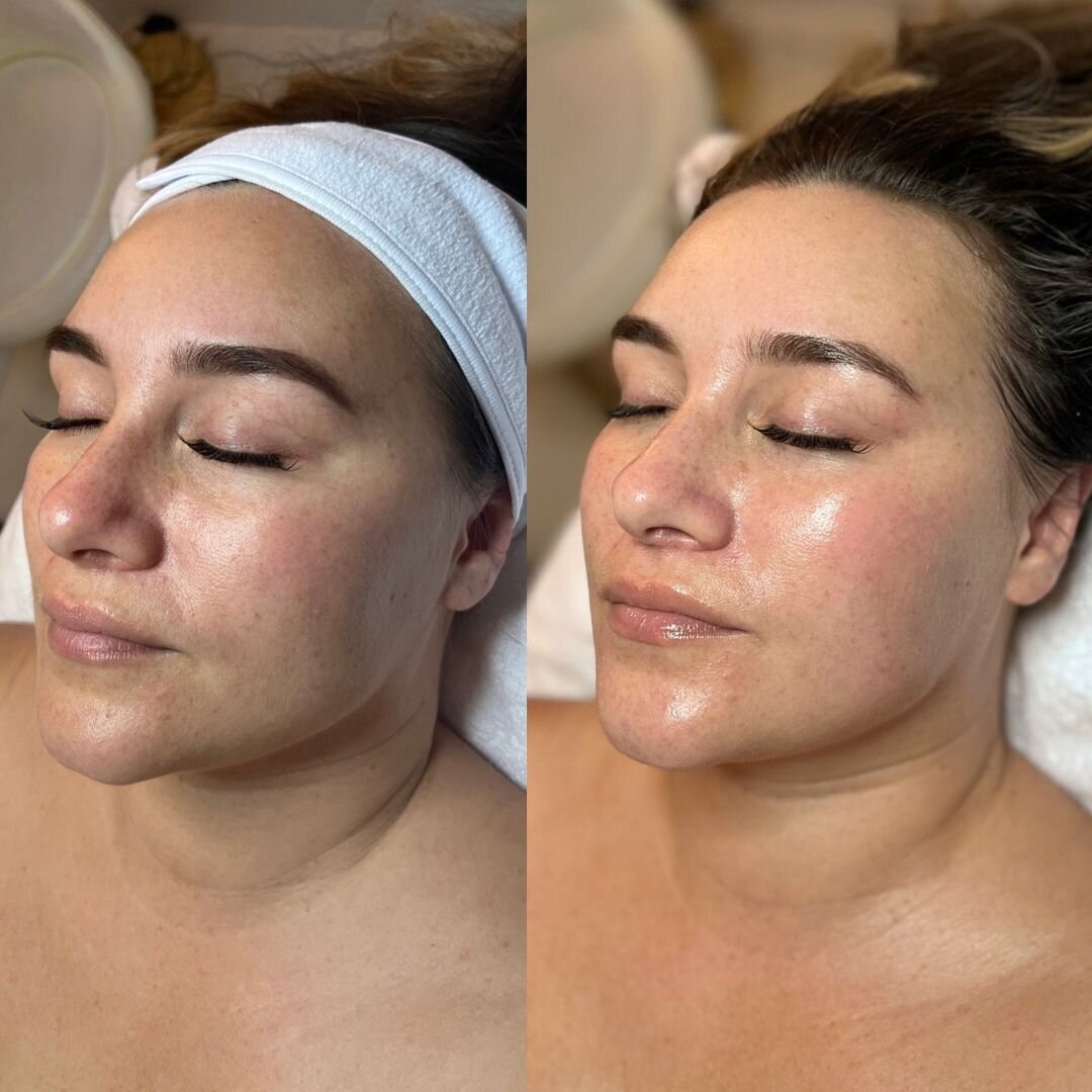 compressed-High-Touch-Medical-Grade-Facials-brand-and b-a-04