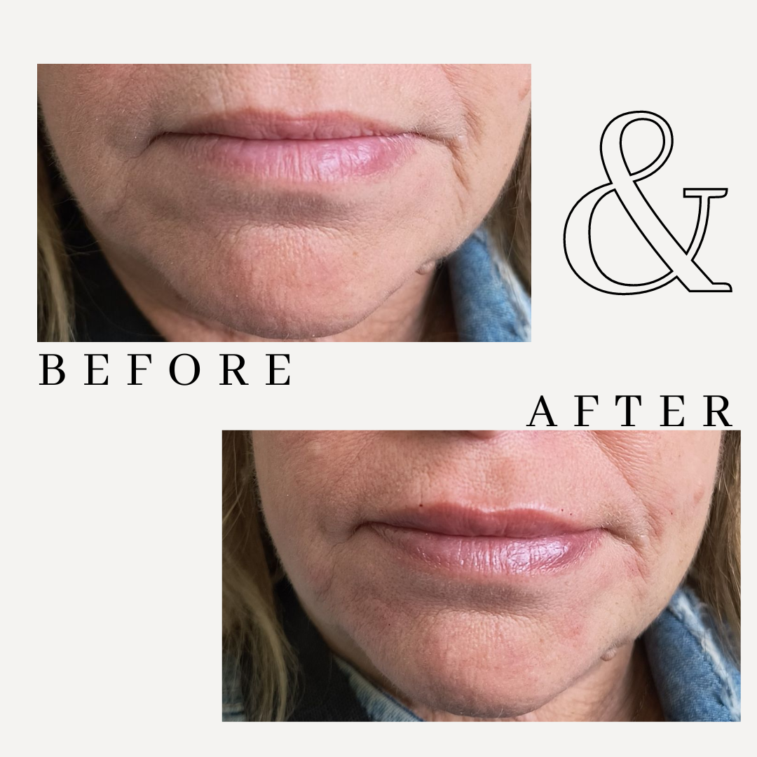 lip hydrration, lower face touch up