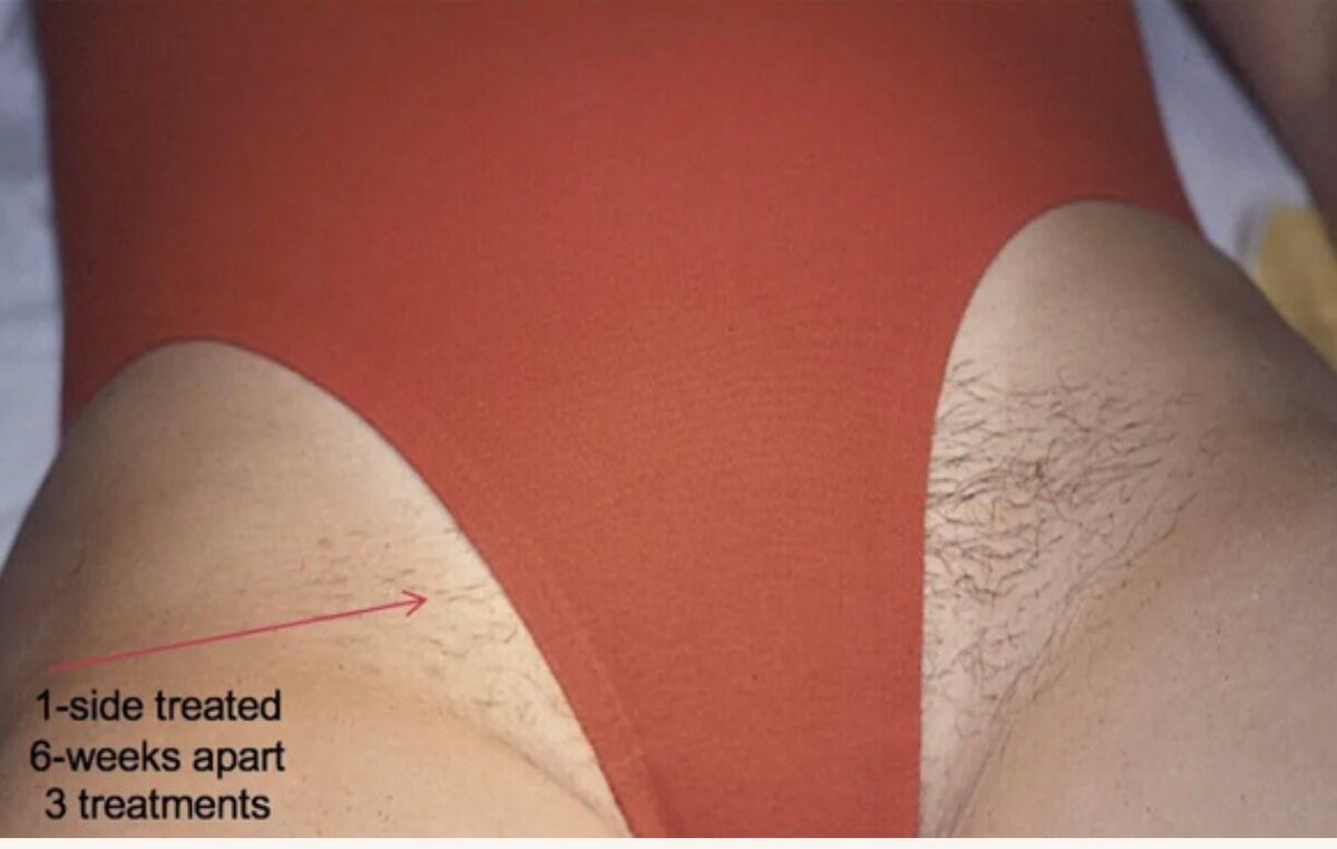 cervello-laser-hair-removal-device-before-after-3