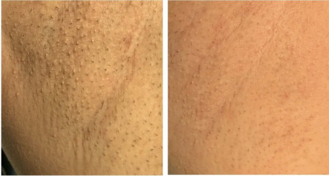 cervello-laser-hair-removal-device-before-after-2