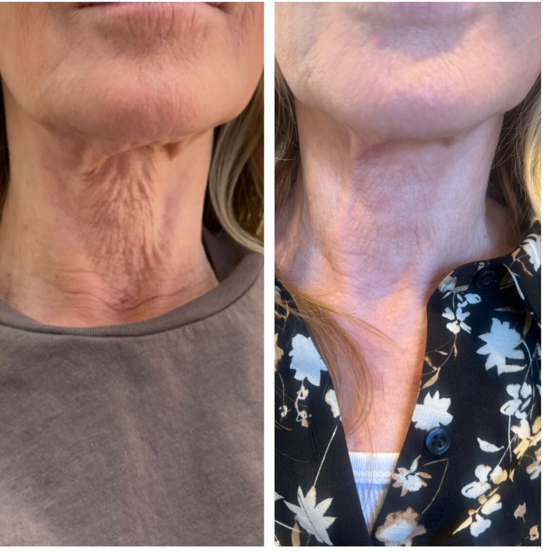 compressed-Hyperdilute-Radiesse-brand-and-before-after-08