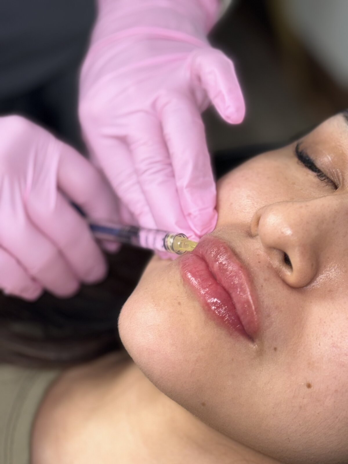 Jamie Young providing Lip Injection Treatment