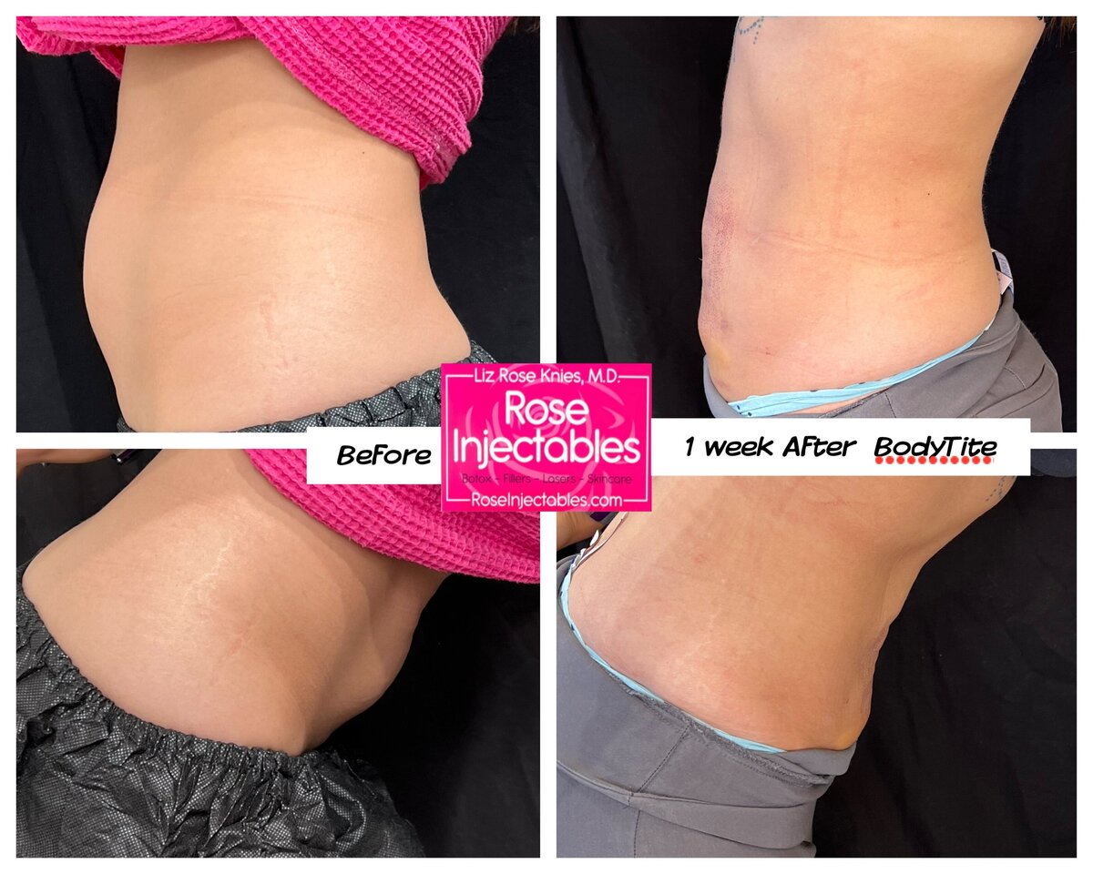 BodyTite-by-Rose-Injectables-Minimally-Invasive-Body-Contouring-Before-and-After-Photos-25
