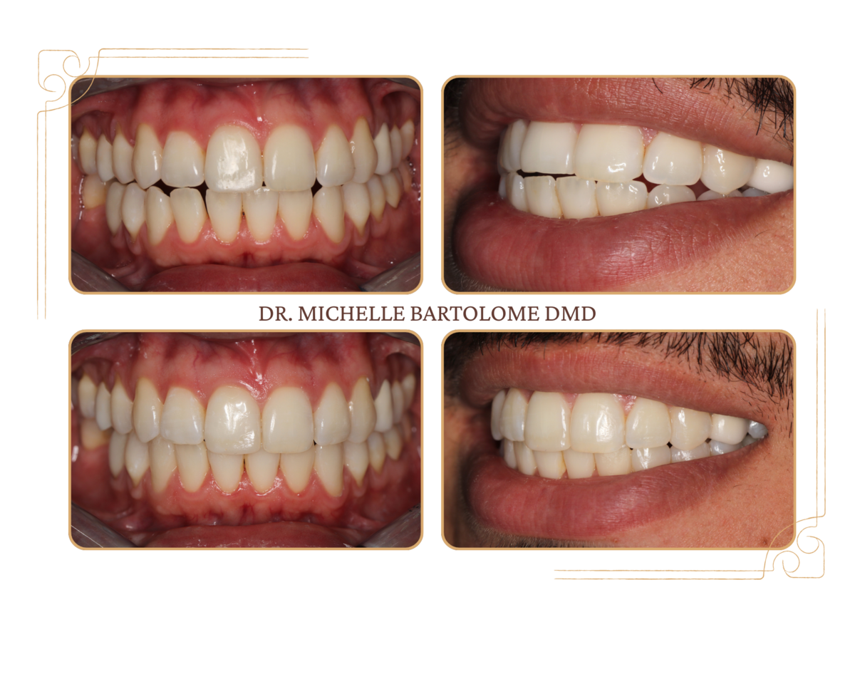 Invisalign (1)