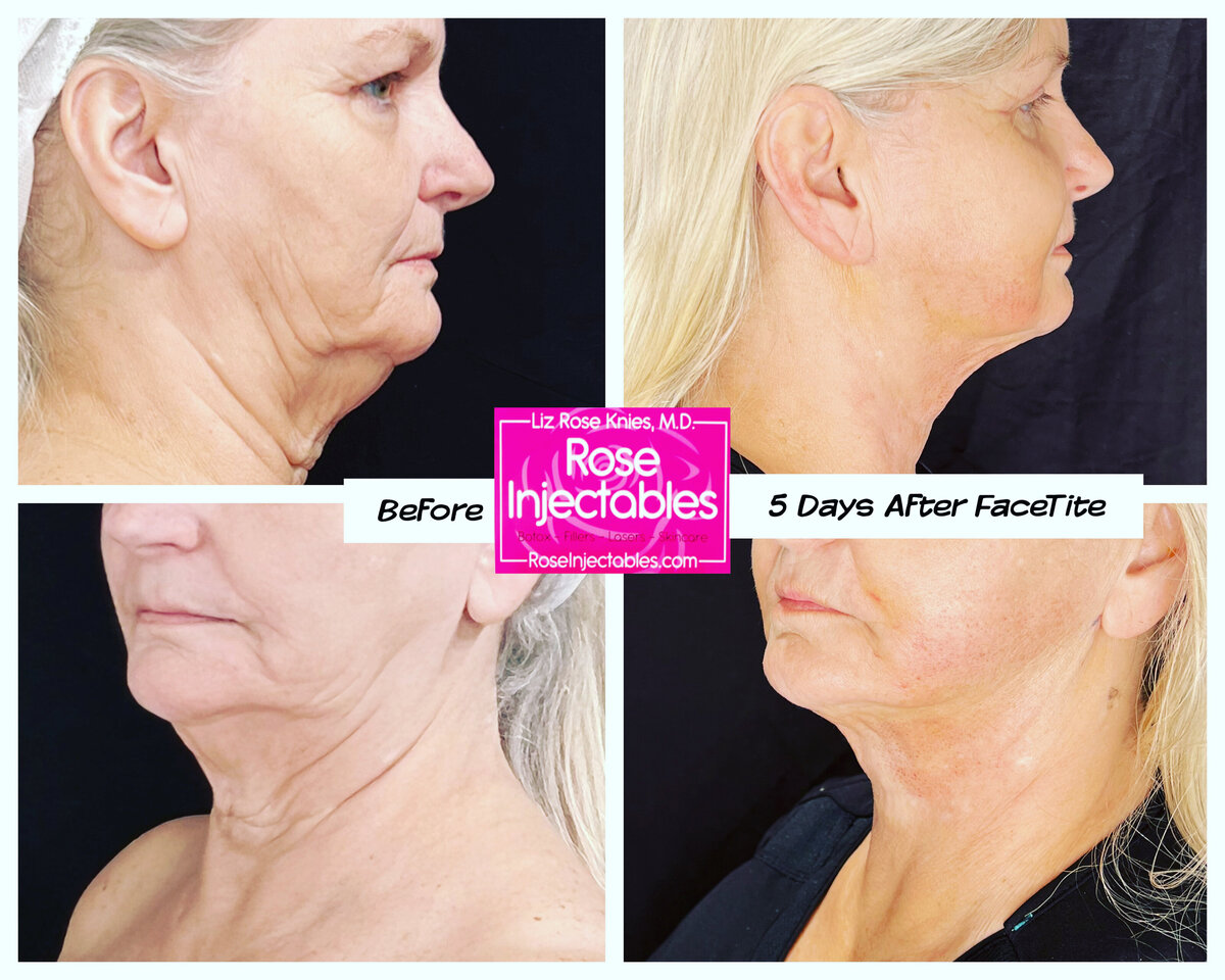 FaceTite-by-Rose-Injectables-Minimally-Invasive-Face-Contouring-Before-and-After-Photos-3