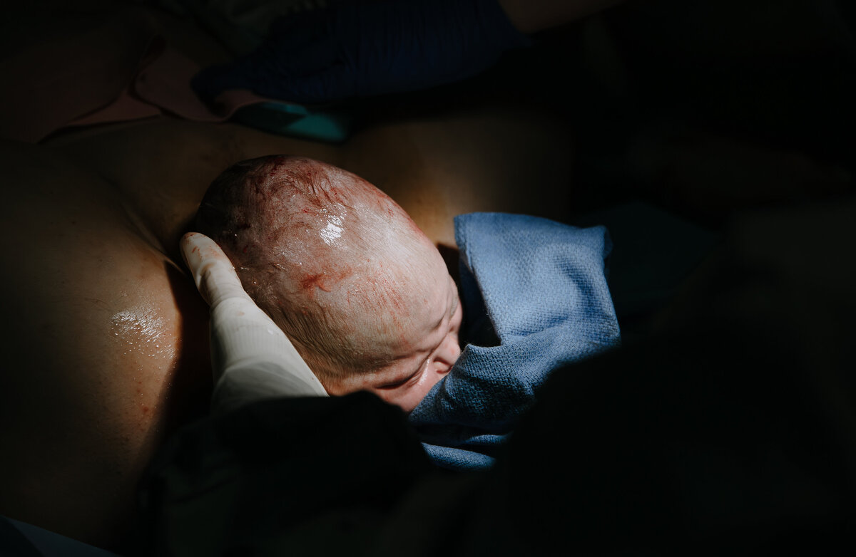 Baby's head exits mother's vagina as doctors helps guide the body out