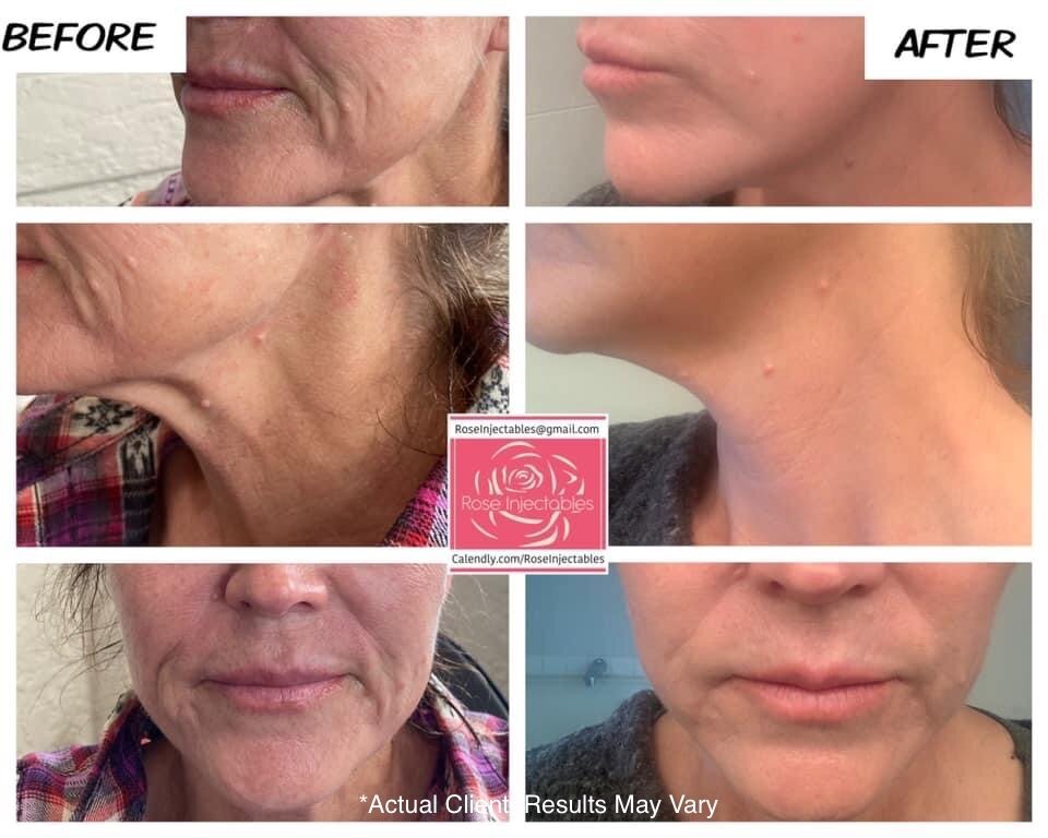 Morpheus8-by-Rose-Injectables-Before-and-After-Photos-71