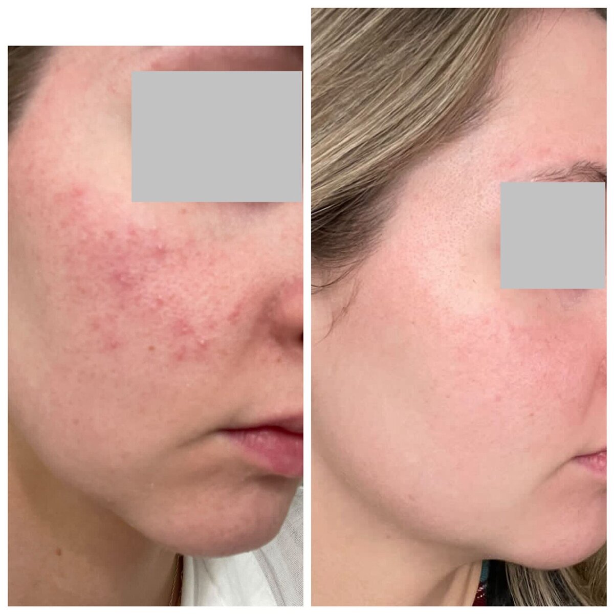Before and after rosacea remission results using holistic skin care techniques.