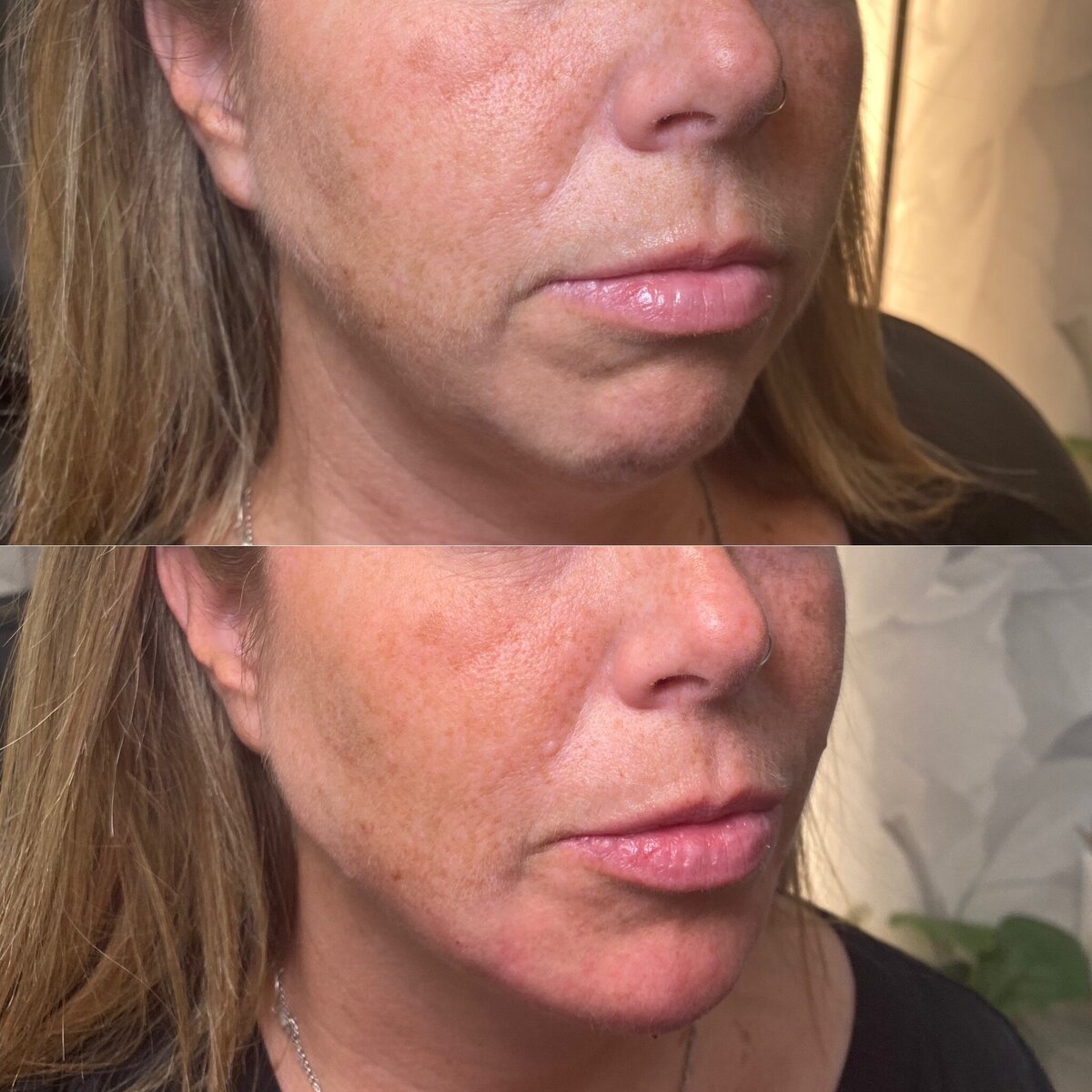 BalancedBeautyBotoxWestwood19