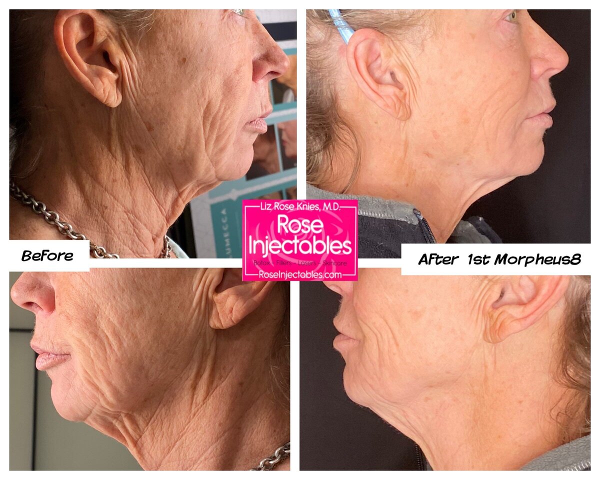 Morpheus8-by-Rose-Injectables-Before-and-After-Photos-45