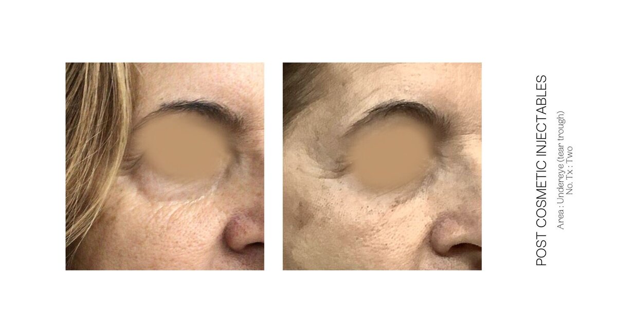 PRP Under Eye Before and After 5