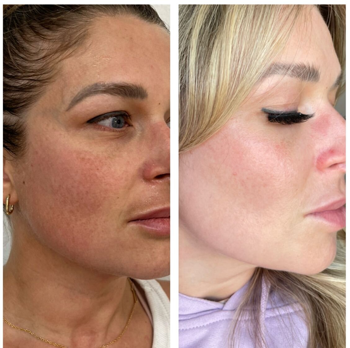 compressed-Moxi- BBL-before-after-13