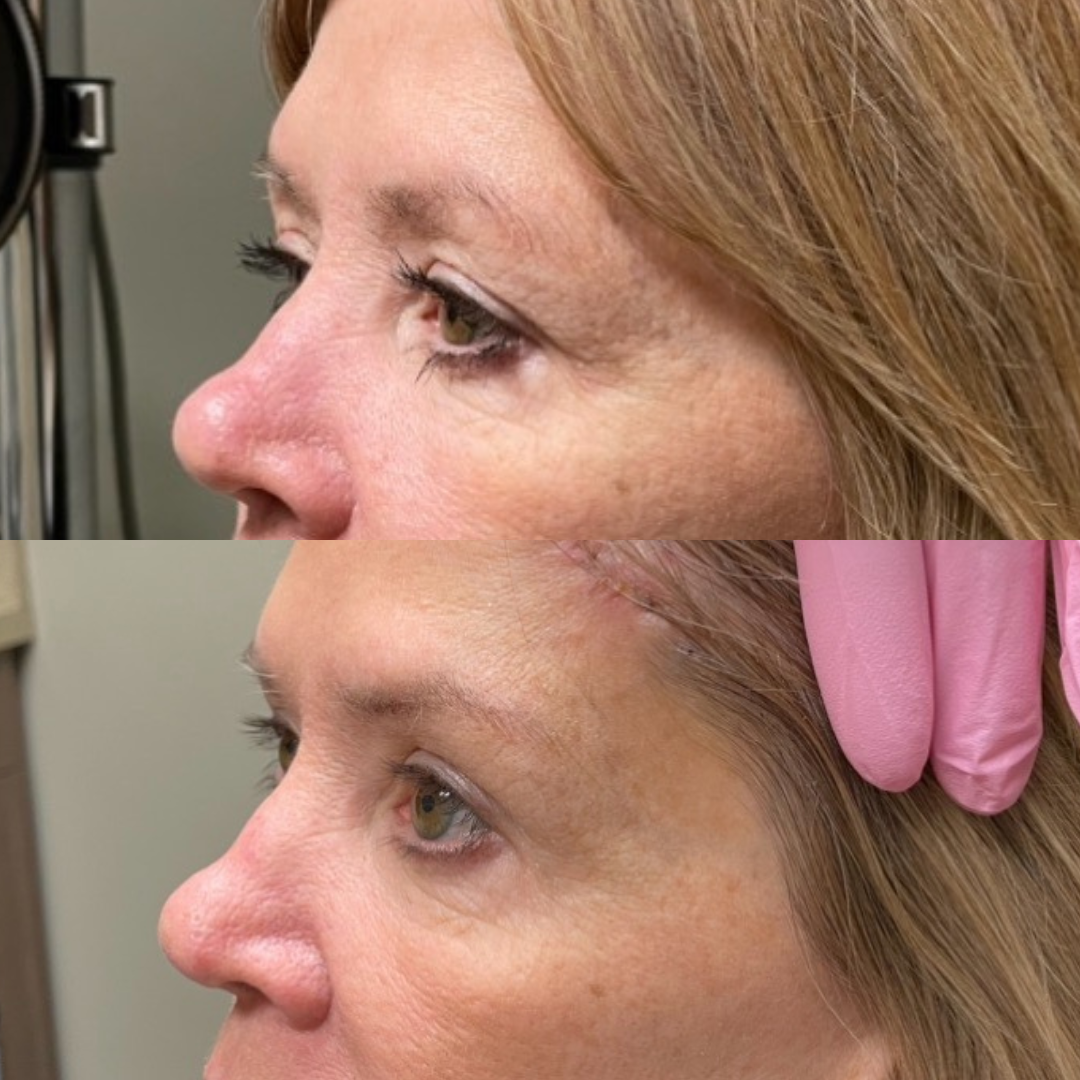 Pretrichial brow ptosis repair