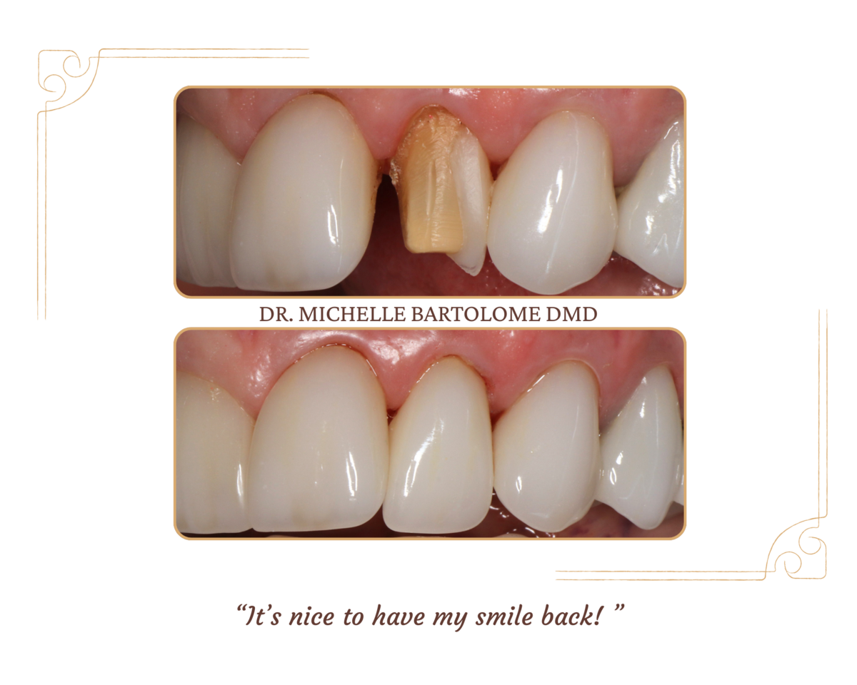 Crown Repair (2)