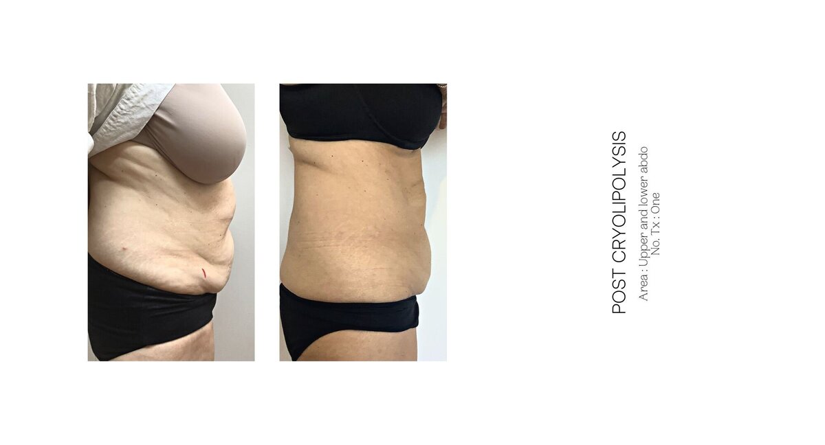 Cryolipolysis Stomach Before and After 8