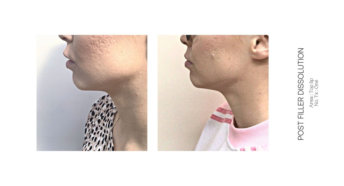 Top Lip Filler Dissolve Before and After 5