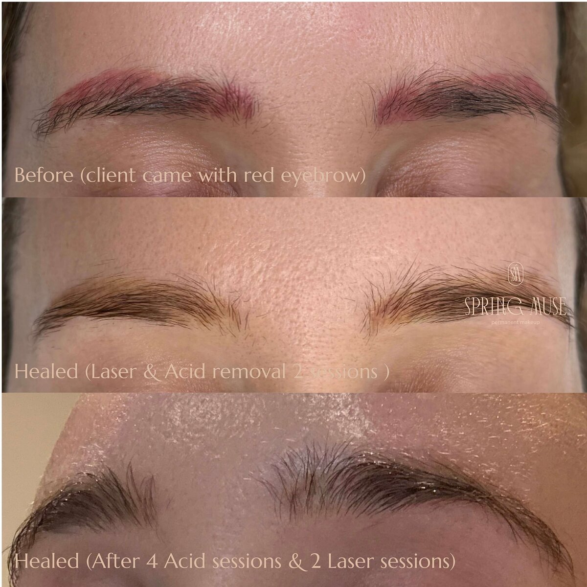 Yellow Brows Removal NYC
