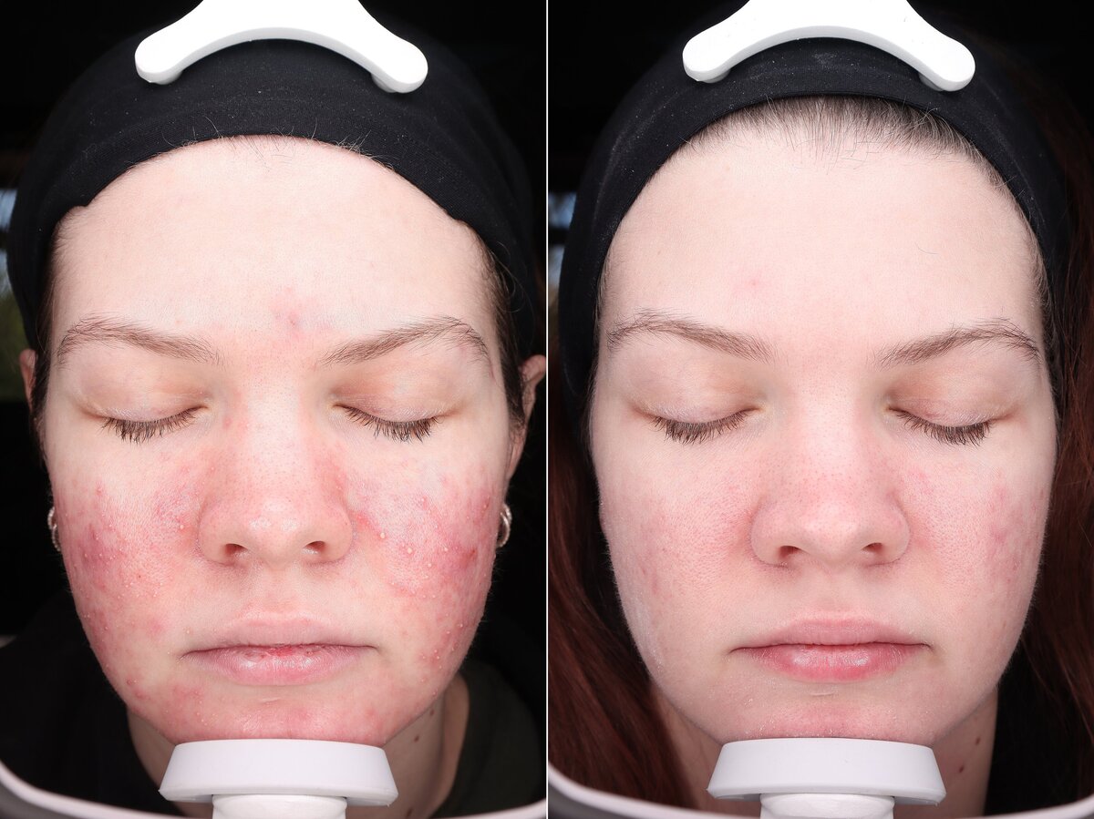 Allure AZ_acne-treatment-before-after-flagstaff-medspa_0039