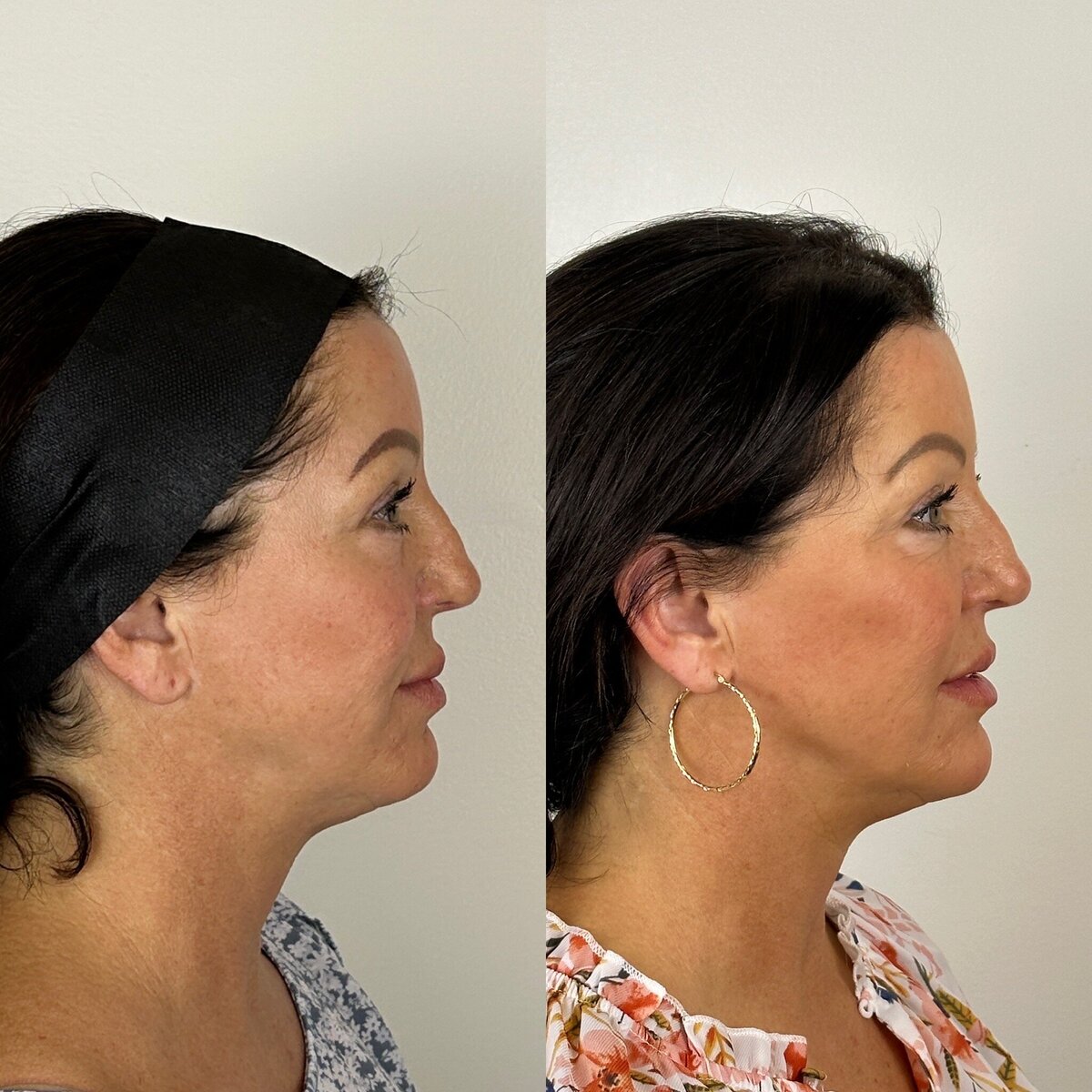 Full Facial Balancing with Botox & Fillers