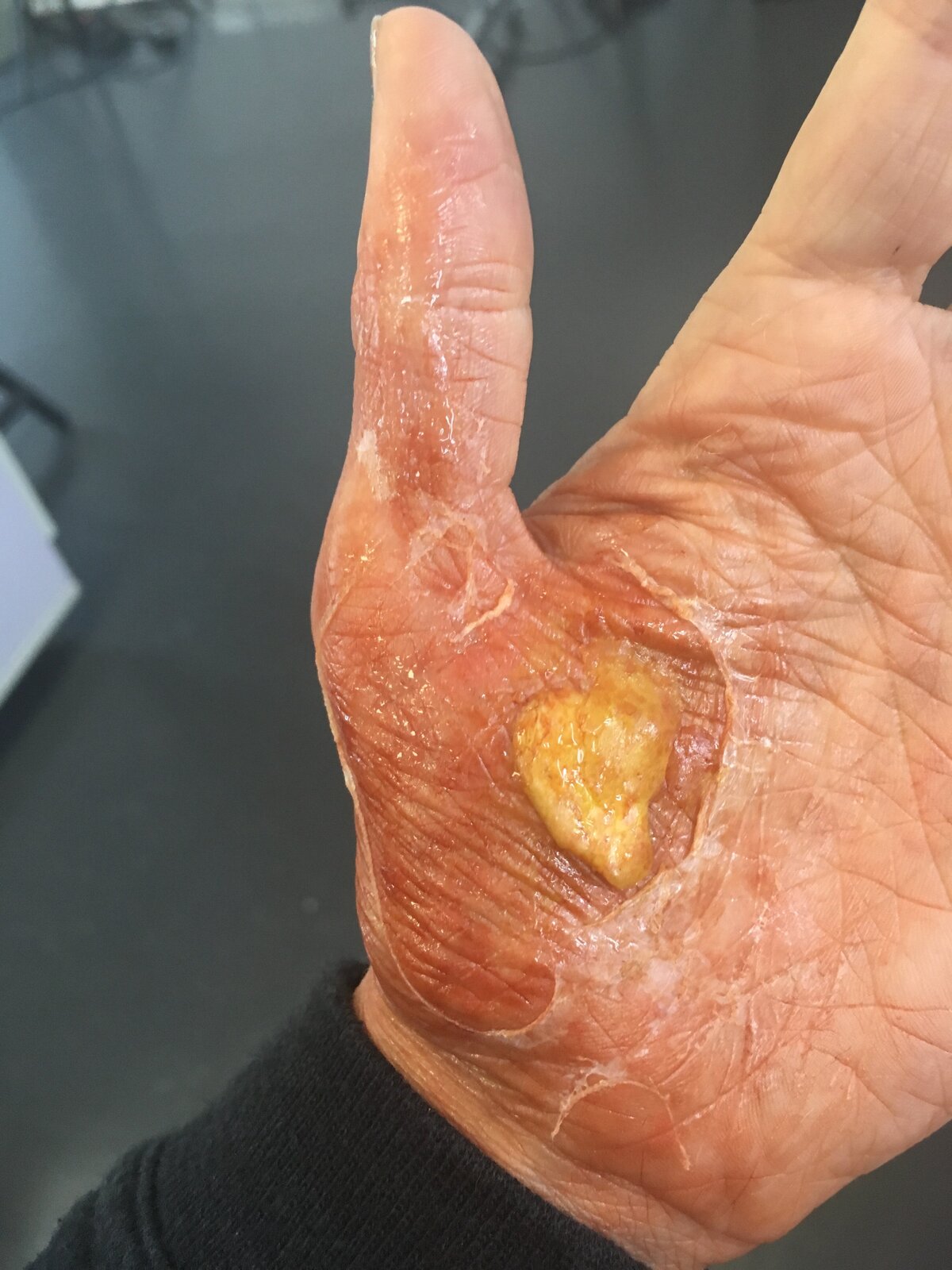 Special effects - skin infection and fungus
