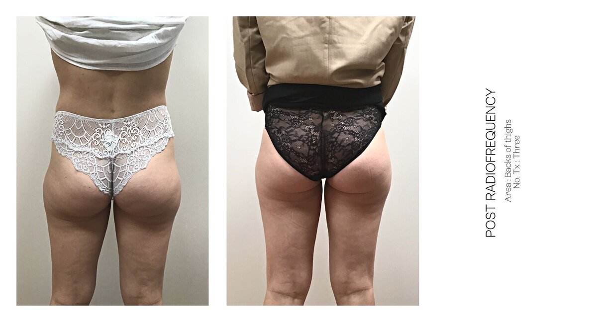 Radiofrequency Thighs Before and After