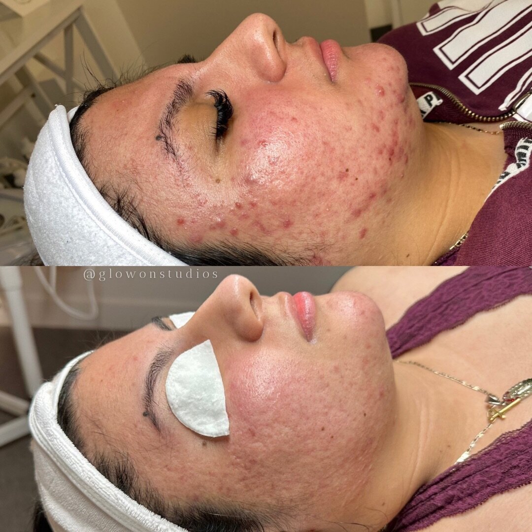Glow-On-Studios-Before-After-Skincare-Sacramento-4