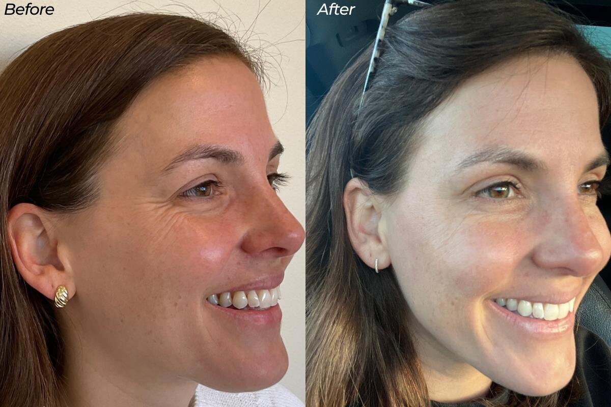 radiance-botox-BNA-1
