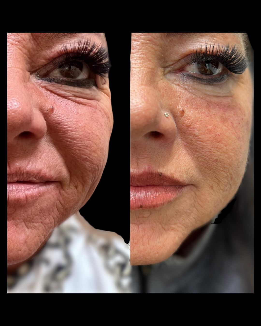 Before-and-after results from facial balancing treatments at Maxwell Aesthetics in Salem, Oregon, including Botox, dermal fillers, lip enhancements, and lower face rejuvenation—designed to enhance natural symmetry and restore youthful contours.