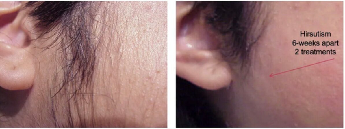 cervello-laser-hair-removal-device-before-after-4