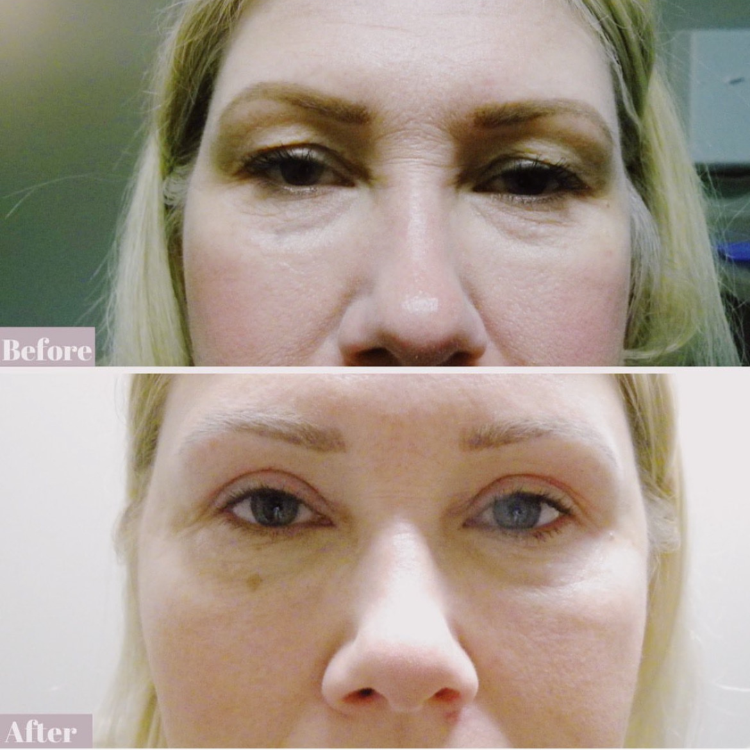 ptosis surgery
