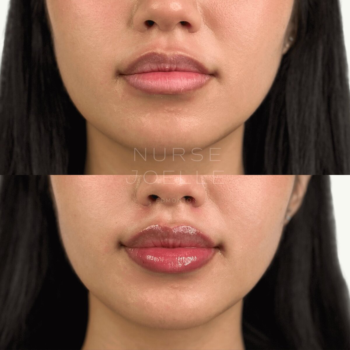 Nurse-Joelle-Cosmetic-Injectables-Before-and-After-6