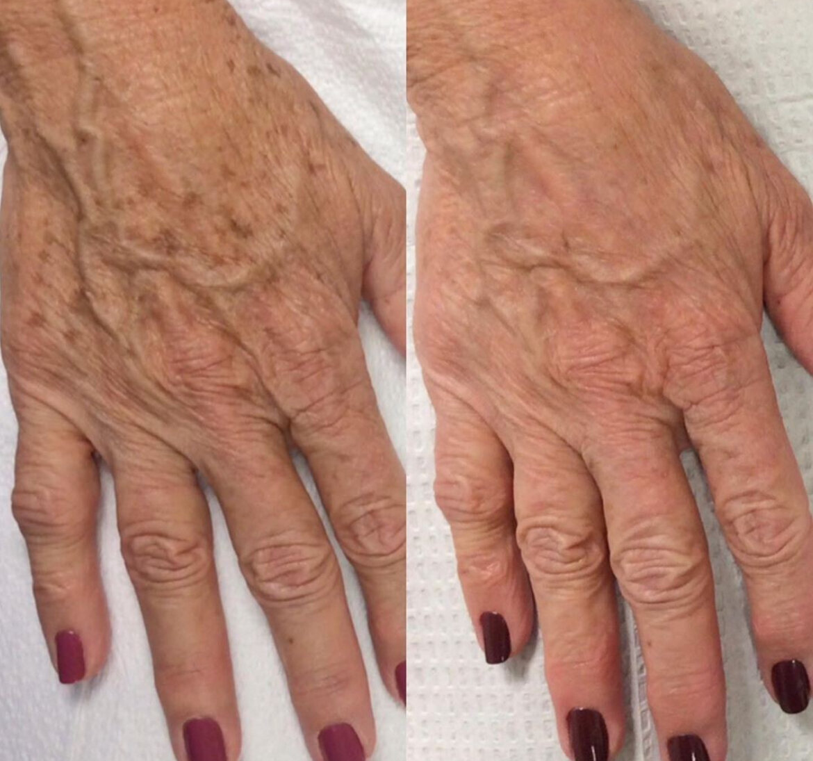 Candela Nordlys skin treatment using PR 530 IPL handpiece to remove brown age spots
