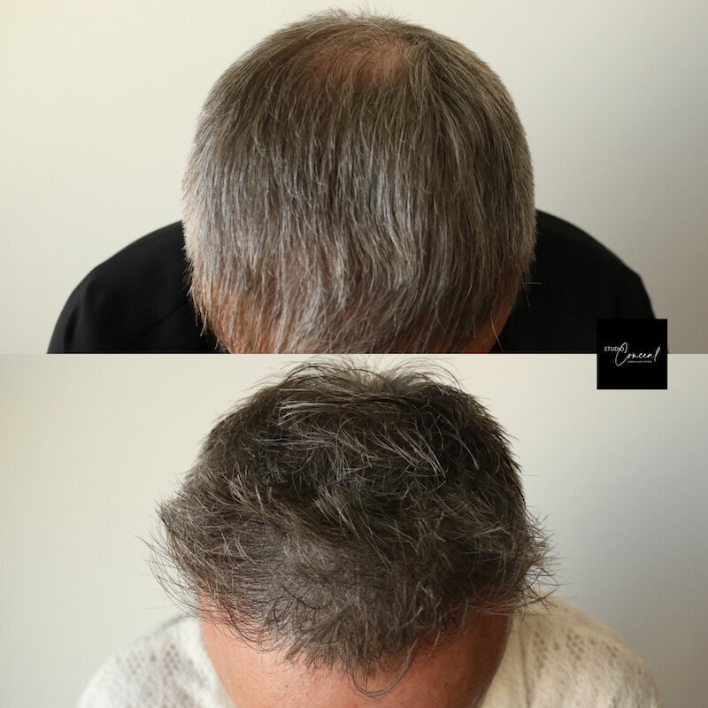 Hair-Loss-Density-Tattoo
