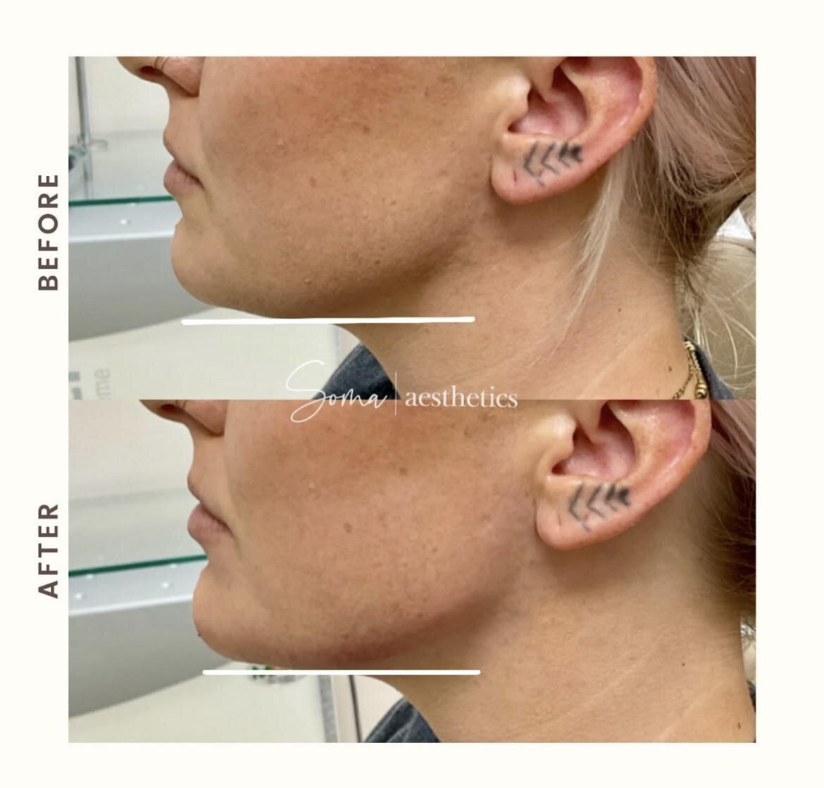 jawline dermal filler 