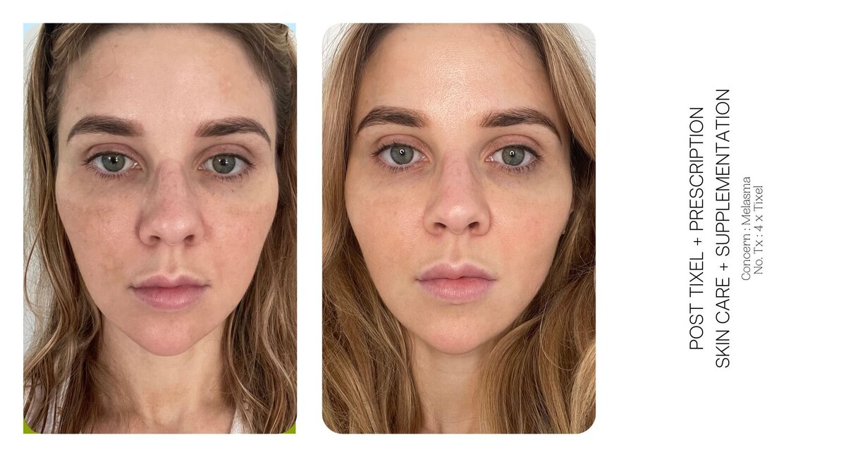 Melasma Before and After 1