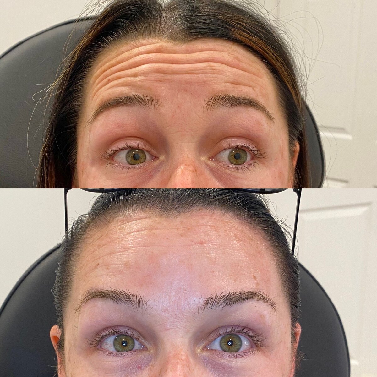 canova-aesthetics-med-spa-before-after-injectables-3