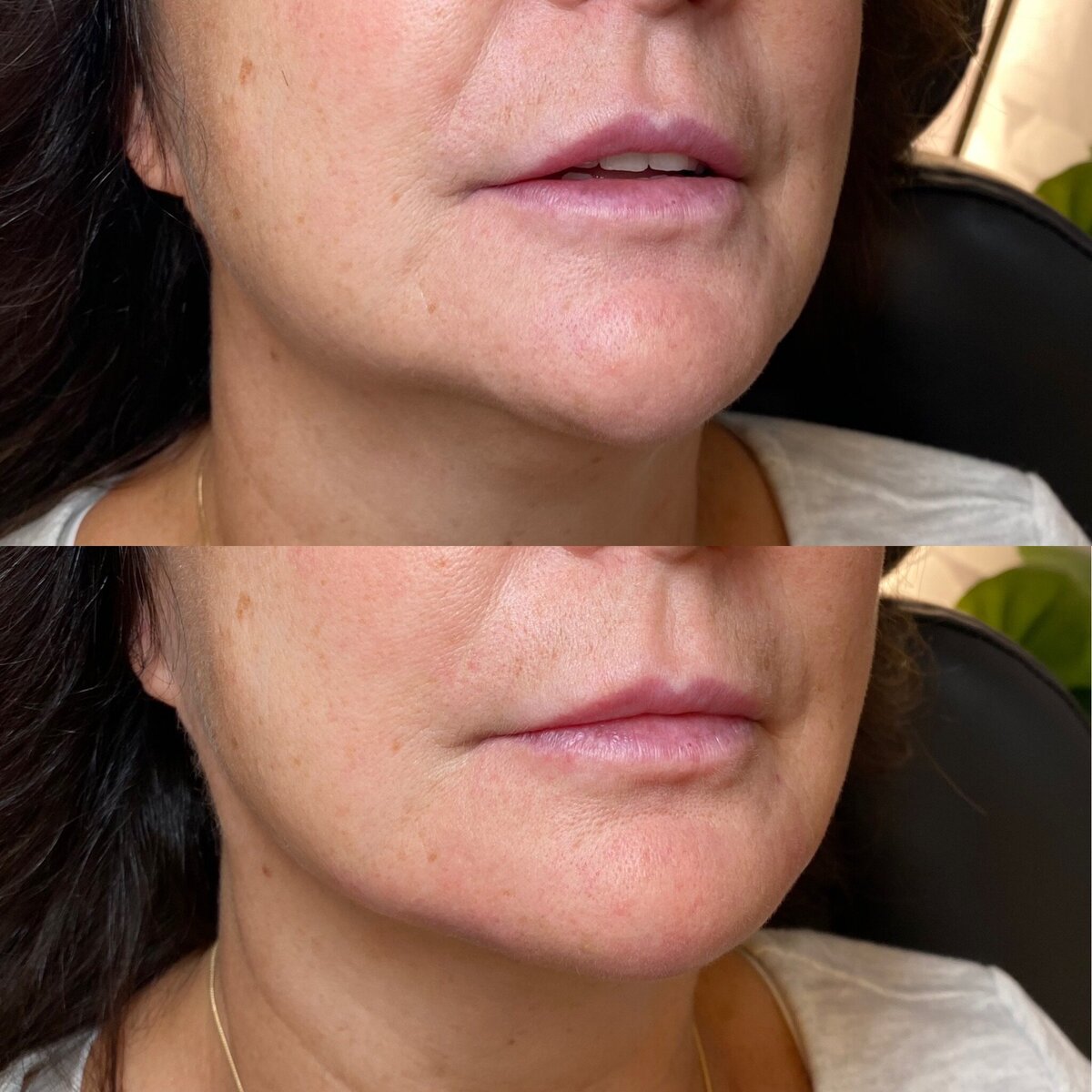 BalancedBeautyBotoxWestwood18